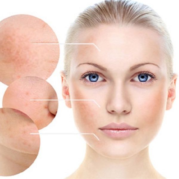 Các phương pháp điều trị nám da hiệu quả